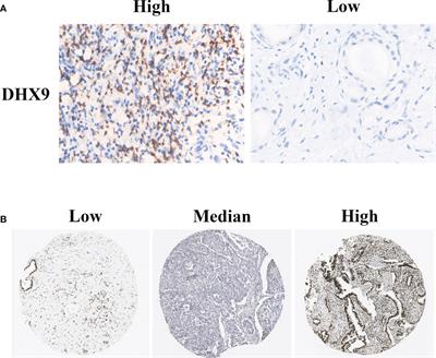 The enigmatic helicase DHX9 as a candidate prognostic biomarker for resected pancreatic ductal adenocarcinoma